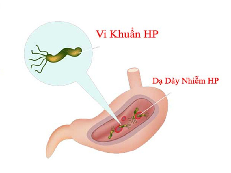 4-dau-hieu-cho-thay-da-day-chua-vi-khuan-hp-de-gay-ung-thu