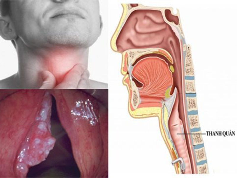 5-dau-hieu-ung-thu-thanh-quan-nhieu-nguoi-thuong-bo-qua