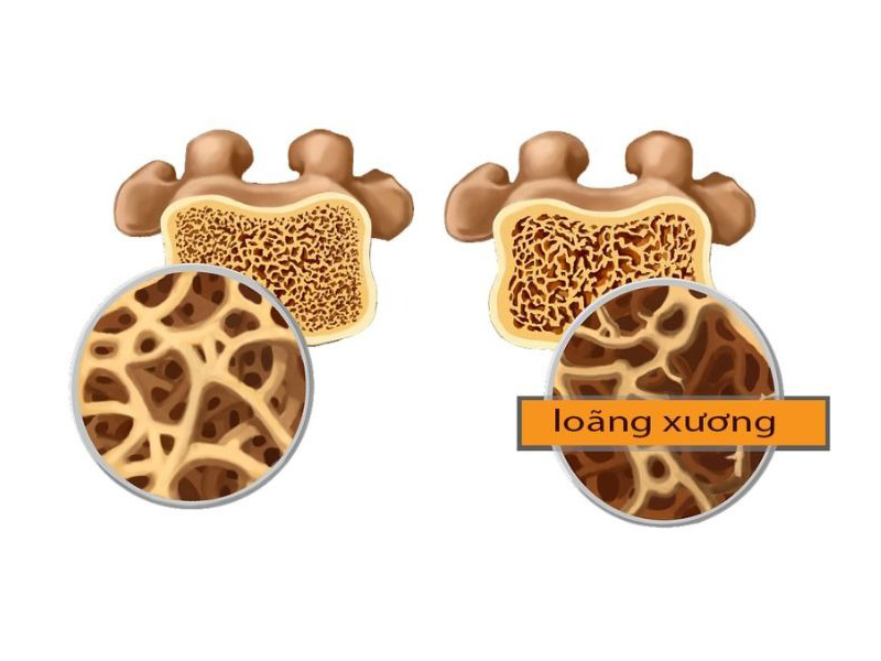 bonecare-calci-max-ho-tro-ngua-loang-xuong