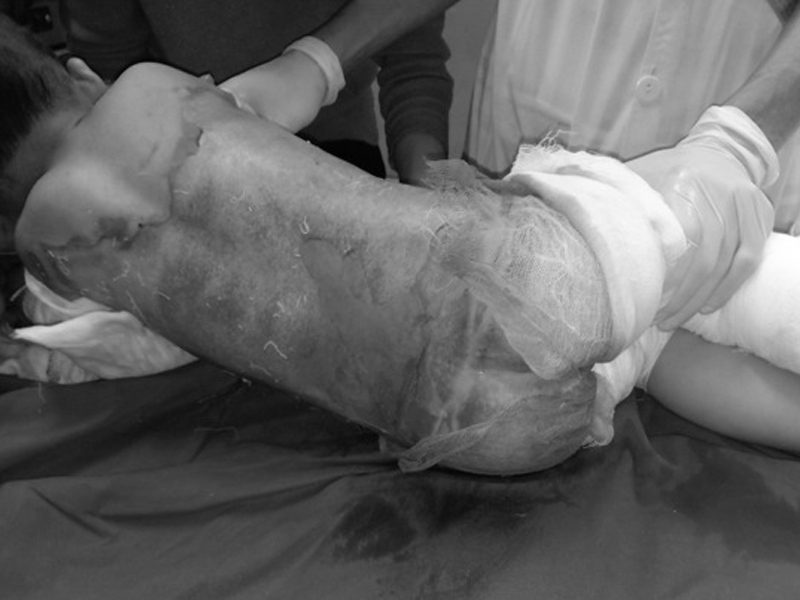 cha-me-bat-can-be-trai-3-tuoi-bi-lot-da-khap-nguoi