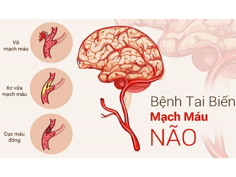 dau-hieu-tai-bien-mach-mau-nao-can-biet-de-khoi-mat-mang