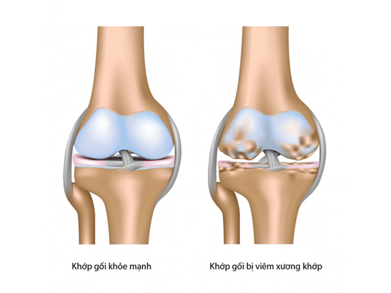hang-trieu-nguoi-viet-bi-thoai-hoa-khop-goi-thay-khop-nhan-tao-het-bao-nhieu