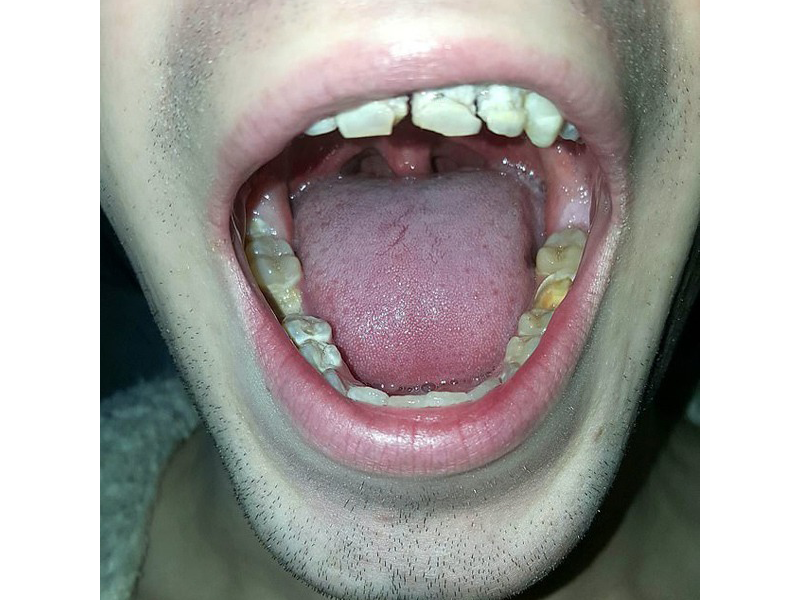 nghien-nuoc-tang-luc-nam-sinh-21-tuoi-muc-gay-het-rang