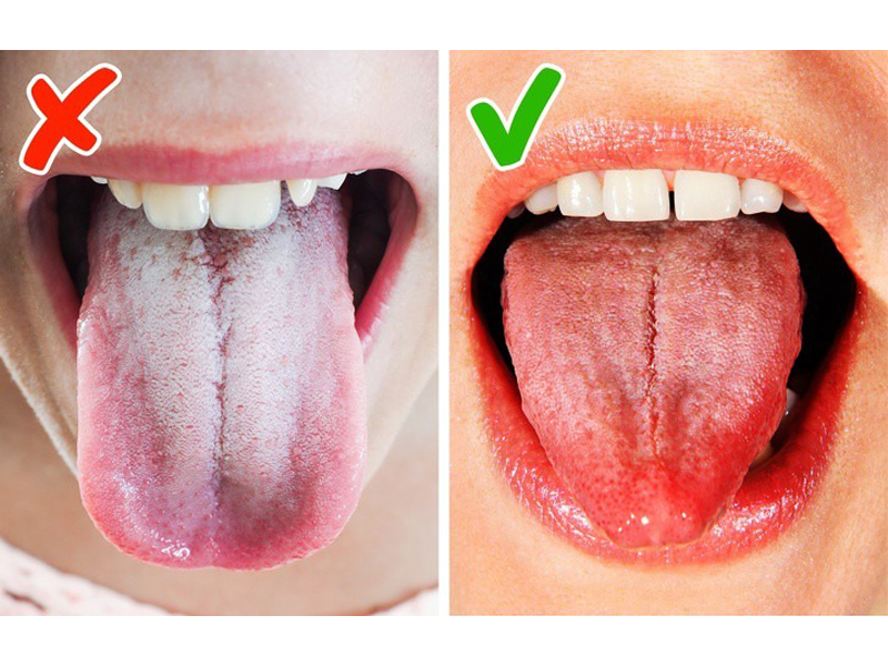 nhung-dau-hieu-o-luoi-cho-thay-ban-dang-mac-benh-nguy-hiem-tham-chi-ung-thu