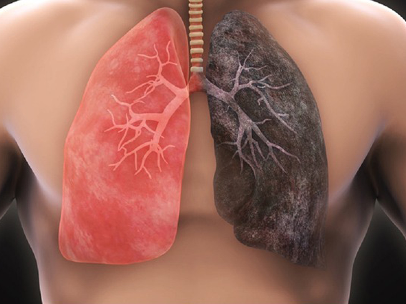 sat-thu-95-trieu-nguoi-viet-tiep-xuc-hang-ngay-lam-tang-22-lan-mac-ung-thu-phoi