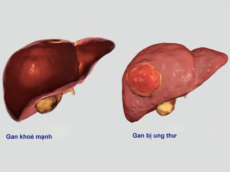 ung-thu-gan-viet-nam-xep-thu-4-the-gioi-gio-co-the-triet-u-khong-can-phau-thuat