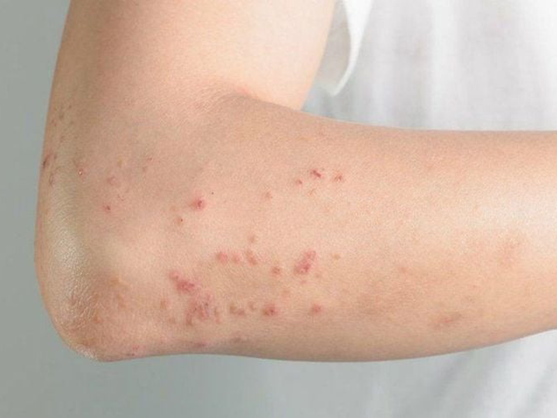 ban sởi có ngứa không