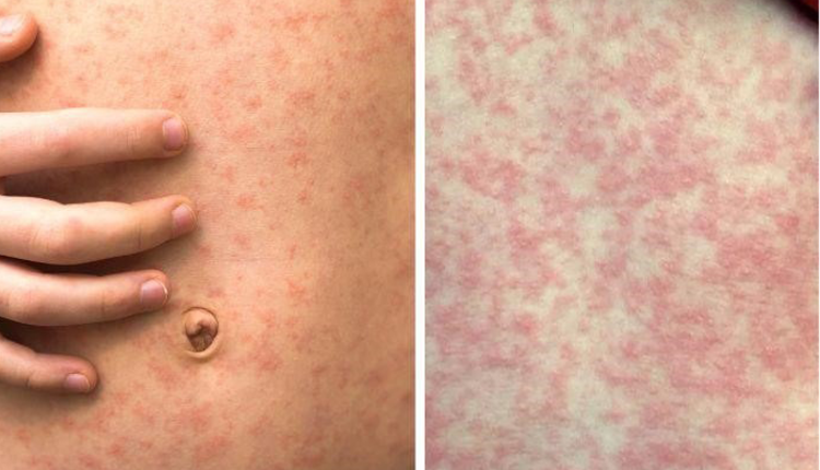 ban-soi-co-ngua-khong-nhung-dieu-can-biet-de-nhan-dien-va-cham-soc-dung-cach