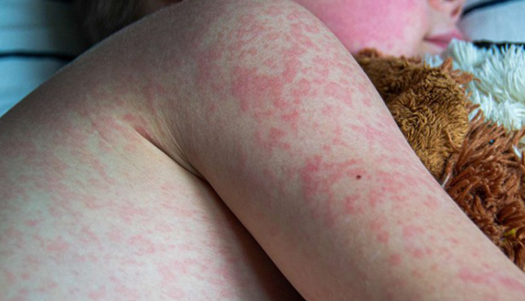 benh-soi-hieu-ro-de-phong-tranh-va-bao-ve-suc-khoe