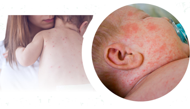 lam-sao-de-nhan-dien-va-phong-ngua-benh-soi-o-tre-em-mot-cach-hieu-qua-nhat