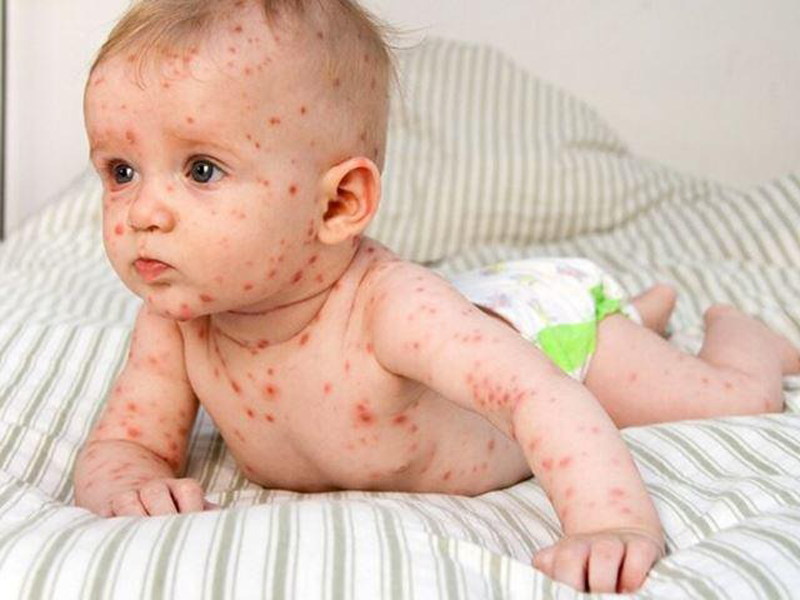 lam-sao-de-nhan-dien-va-phong-ngua-benh-soi-o-tre-em-mot-cach-hieu-qua-nhat