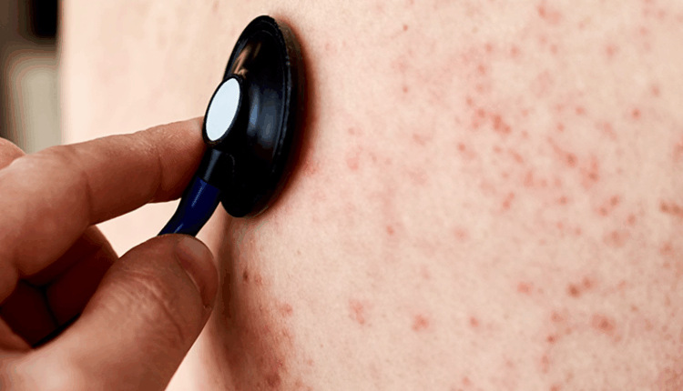 phan-biet-ban-soi-va-sot-phat-ban-huong-dan-chi-tiet-de-hieu-cho-moi-nguoi